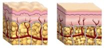 cellulite-narancsbor.jpg